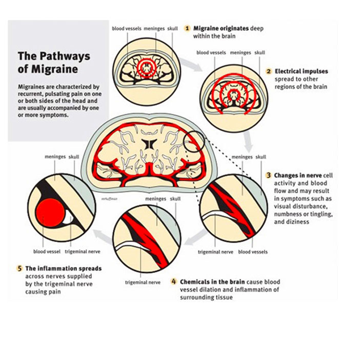 Migraine pegasus4 - Migraines: More Than “Just A Headache”