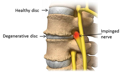 degenerative disc disease dallas