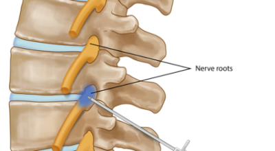 Nerve Root block dallas