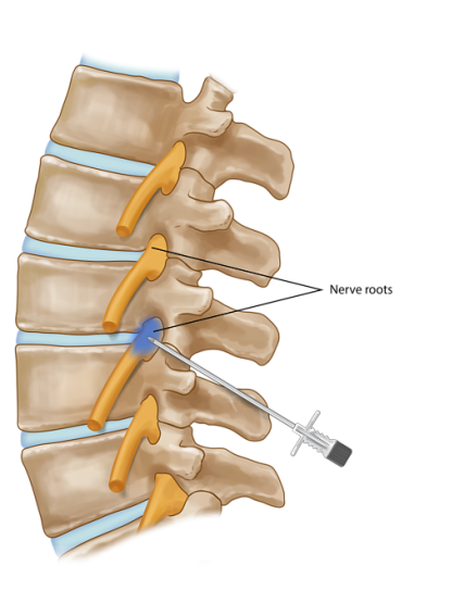 Nerve Root block dallas