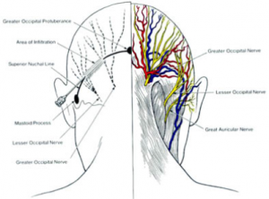 occipital nerve block dallas