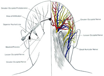 Occipital Nerve dallas occipital nerve block dallas