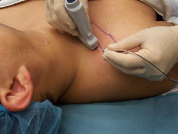 Peripheral Nerve Blocks Stellate Ganglion Blocks