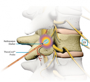 Radiofrequency Ablation dallas