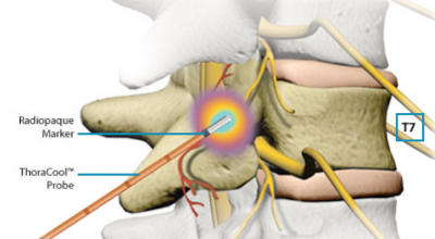 Radiofrequency Ablation dallas