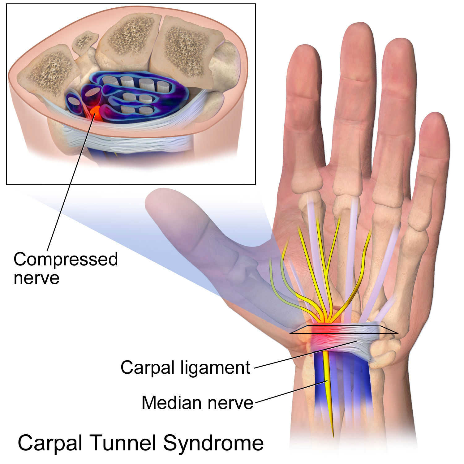 carpal tunnel dallas