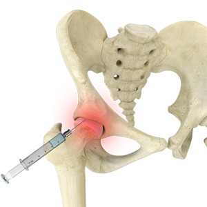 Steroid injections for pain in hip