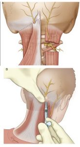 occipital nerve block dallas