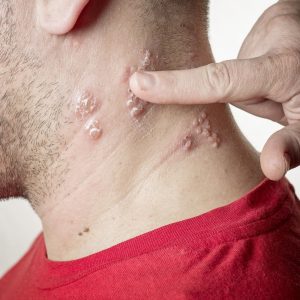 shingles pain dallas
