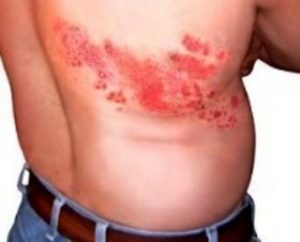 shingles treatment dallas