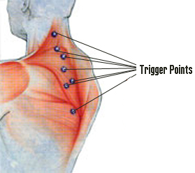 Trigger Point Injections dallas
