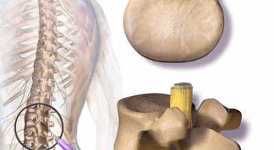 Caudal Steroid Injections dallas