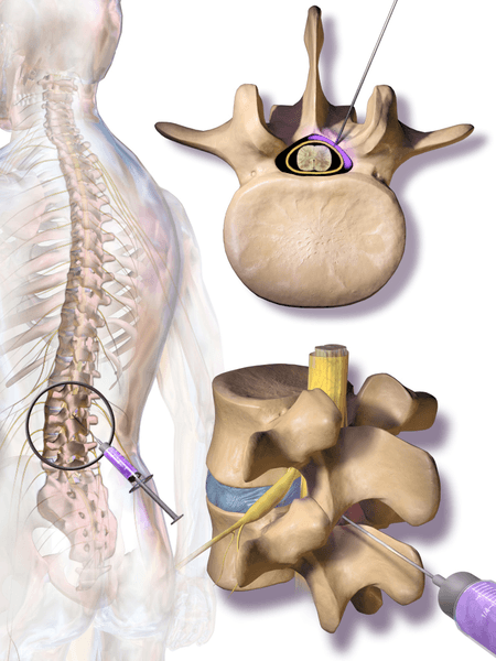 Caudal Steroid Injection - Sacroiliac Joint Injections