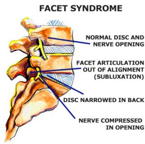 Facet Syndrome dallas