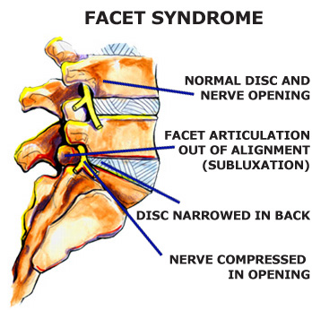 Facet Syndrome dallas