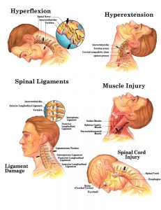 whiplash treatment dallas