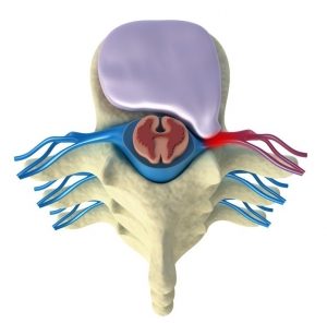 Intradiscal Biacuplasty dallas