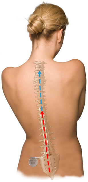 Spinal Cord Stimulation - Spinal Cord Stimulator