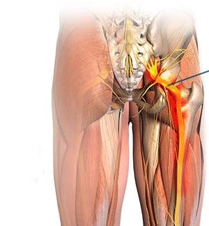 sciatic-nerve-pain