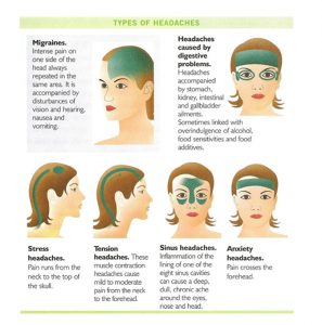 types of migraine headaches dallas