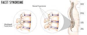 facet syndrome treatment dallas