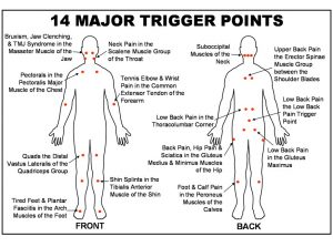 Trigger Point Injections for pain dallas