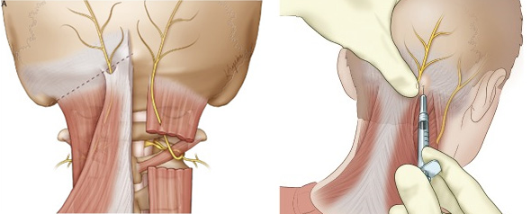 occipital nerve block